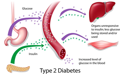 Type 2 Diabetes